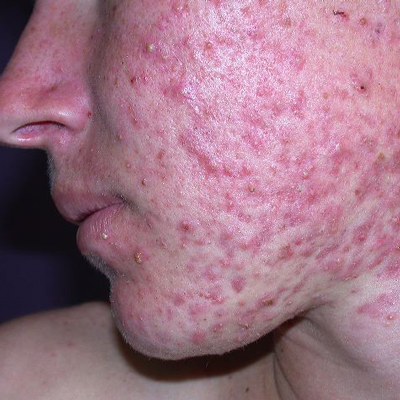 Bad acne after steroids