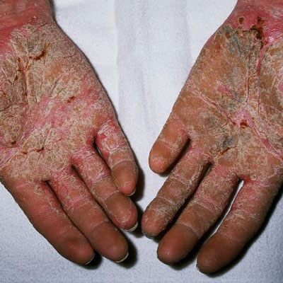 red patches on hands #11