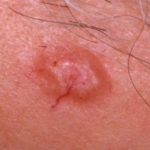 Basal Cell Carcinoma - Miller Family Dermatology | Arlo Miller ...