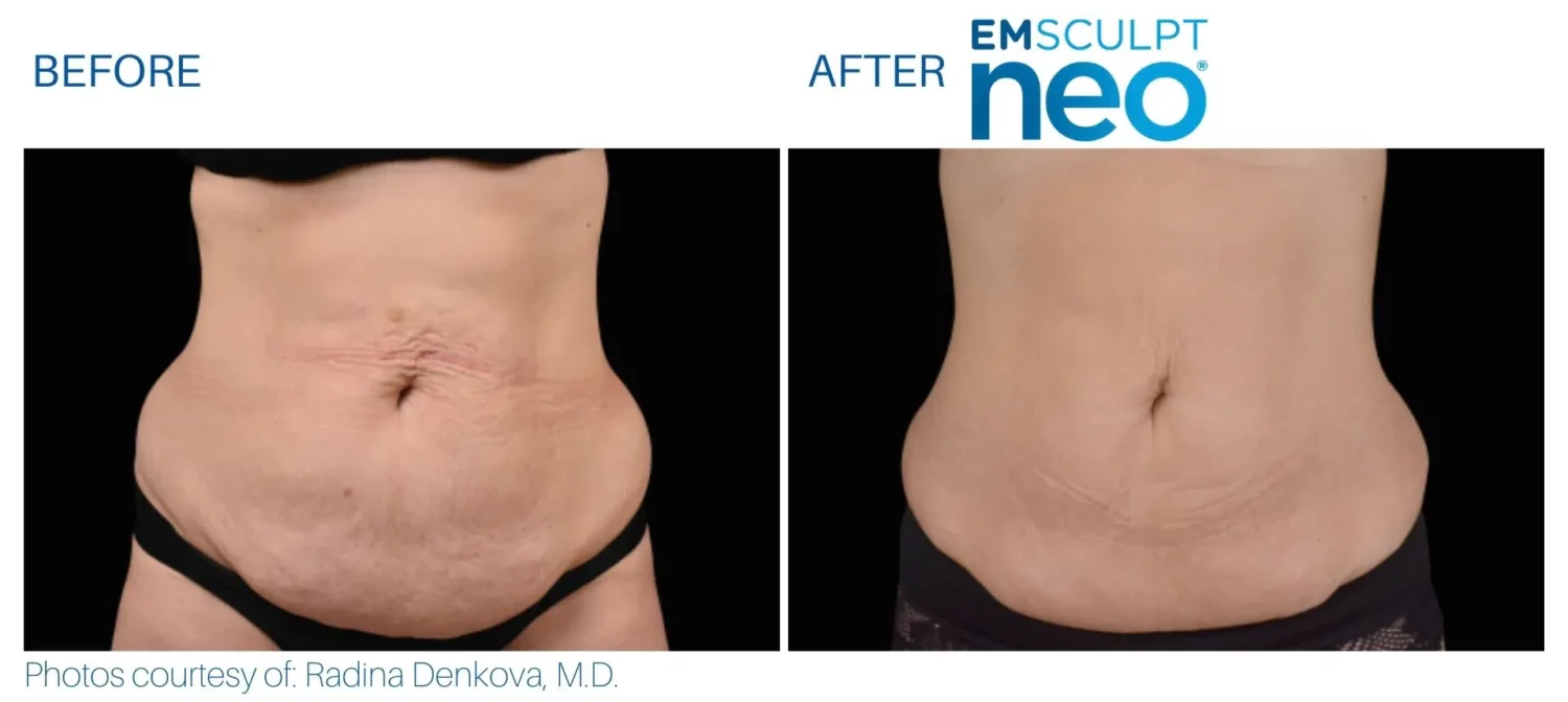 EmSculpt NEO before and after abs near Issaquah WA