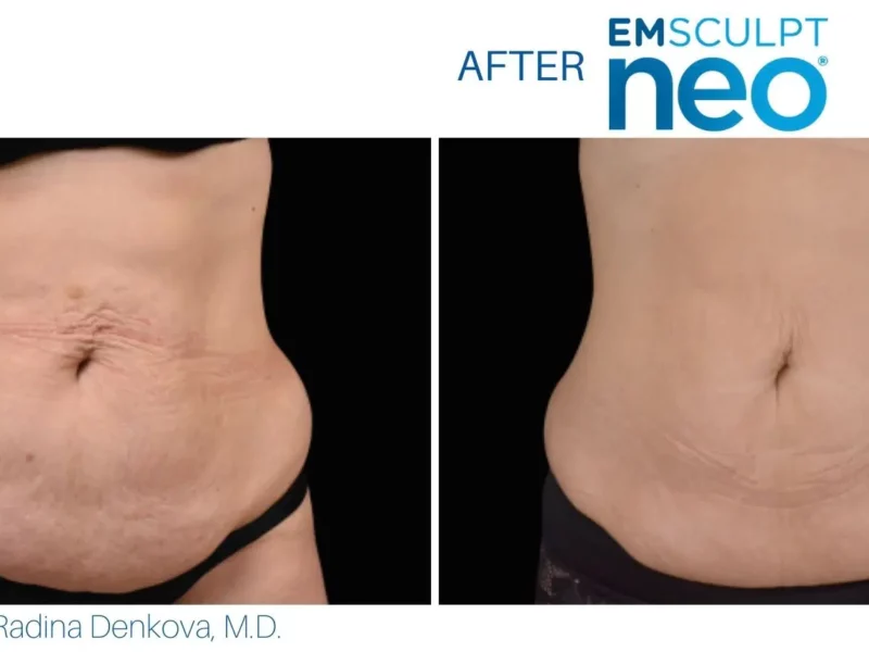 Cost of CoolSculpting near Seattle