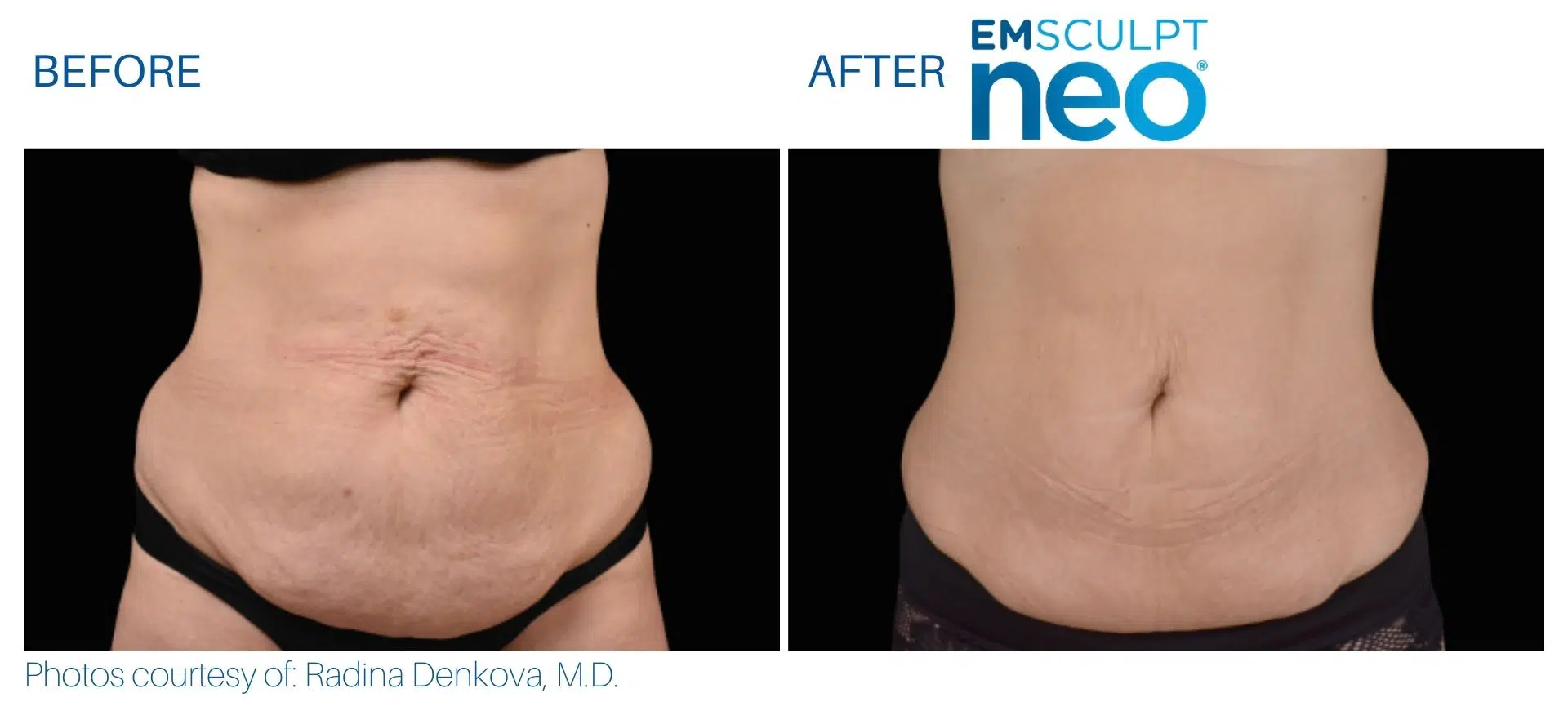 Cost of CoolSculpting near Seattle