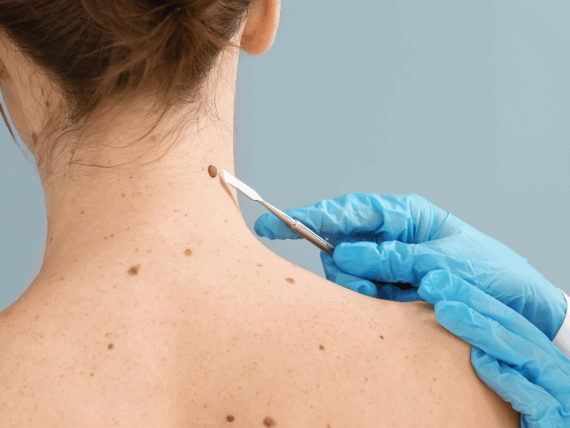 mole removal near snoqualmie