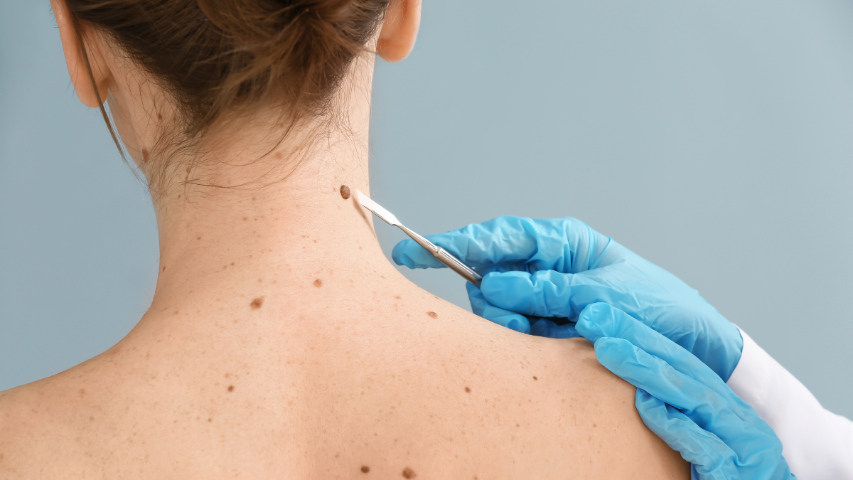mole removal near snoqualmie