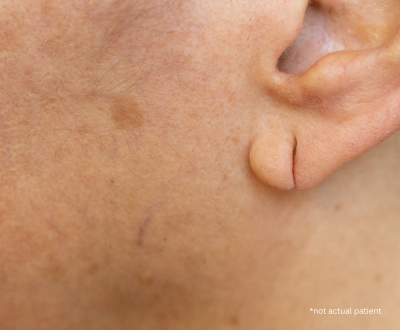 Earlobe Repair in Issaquah, WA: Restore Torn or Stretched Earlobes