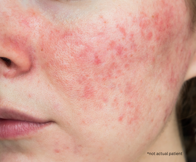 Rosacea Treatment in Issaquah, WA How to Identify and Avoid Common Triggers