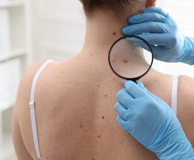 Doctor examining woman's moles in hospital, closeup