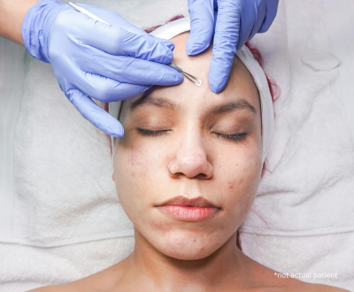 Understanding the Different Types of Acne in Issaquah, WA