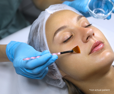 Which Chemical Peel in Issaquah, WA Is Right for Your Skin?
