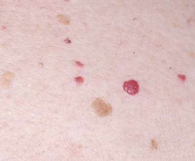 cherry angioma removal seattle